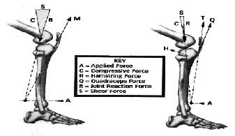 Anterior Cruciate Ligament Reconstruction